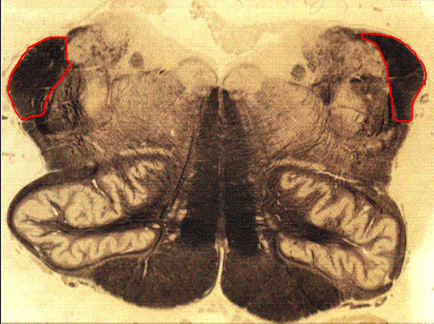 <p>[aka "restiform body"]</p>