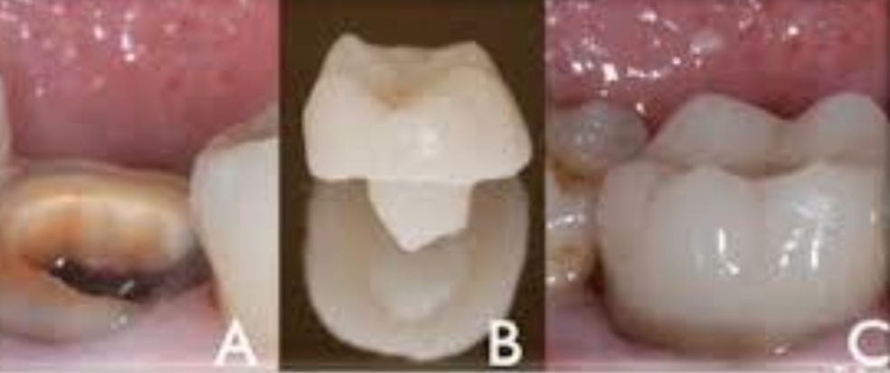 <p>For rtc teeth with significant structure loss, where normal crown not possible. Anchored within remaining tooth.</p>