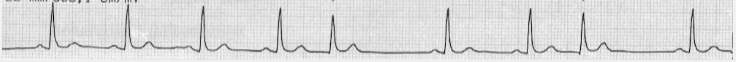 <p>early in the cardiac cycle; no P, inverted P, or post-QRS P wave</p>