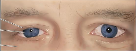 3 signes :
-myosis : diminution du diamètre pupillaire
-ptosis : abaissement de la paupière
-enophtalmie : rétraction de l'œil
d'autres signes non obligatoires :
-réduction de la sudation
-augmentation de la température cutanée et rougeur de la face et du cou