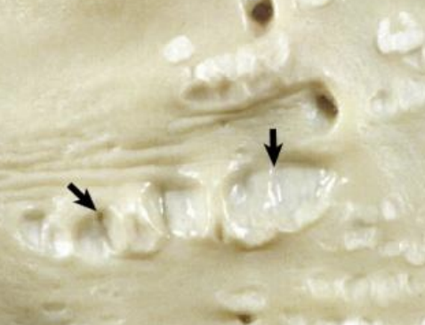 <p>What degenerative condition can occur involving artery hardening, intimal fibrosis, age-related turbulent blood flow, chronic causes, lumen narrowing, forms firm white plaques, and increases in smooth muscle cells?</p>