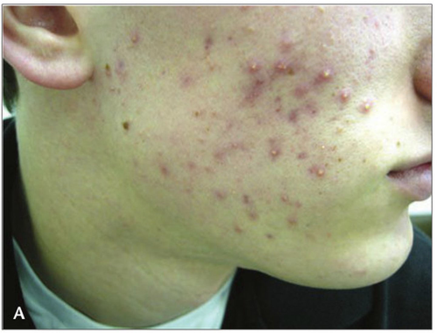 <p>CA: Cutibacterium acnes<br>MOT: - not contagious<br>Si/Sx: -papules/pustules -whitehead/blackheads -inflammation, crusting, scarring<br>Dx: -Hx -PE<br>Tx: -cleanser -Vit. A derivatives (accutaine) -ABX (clindamycin)</p>