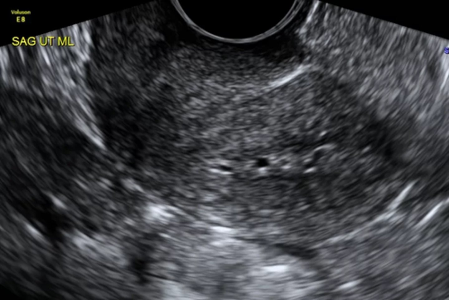 <p>Endometrial hyperplasia</p><p>-A heterogeneous endo with cystic changes is most likely hyperplasia</p>