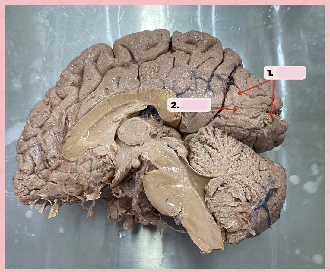 <p>Damage to Area 17 (Pin #2) may present with the following symptoms in a patient:</p><p>a. Lower extremity weakness</p><p>b. Upper extremity weakness</p><p>c. Visual Impairment</p><p>d. Impaired sensations from the limbs and trunk</p>