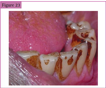 <p>Tenacious __________ on the cervical margin of the teeth in a _____________.</p>