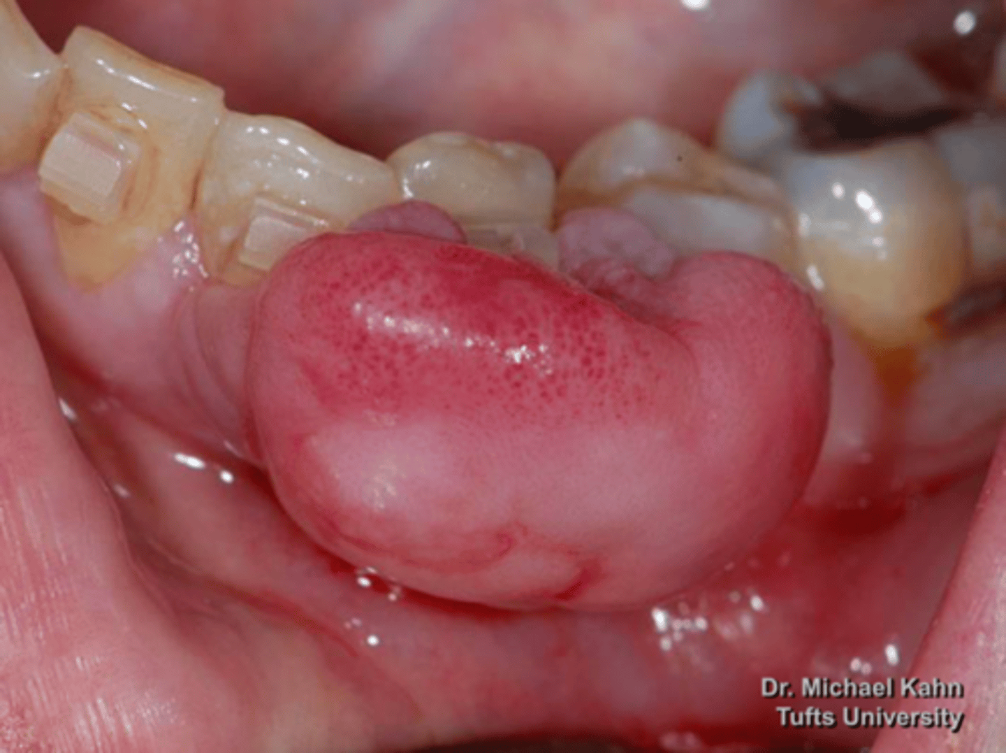 <p>patient presents with pink nodule on the facial aspect of the mandibular gingiva. Histopathology shows fibrous proliferation with formation of mineralized (osseous) product. What do you suspect?</p>