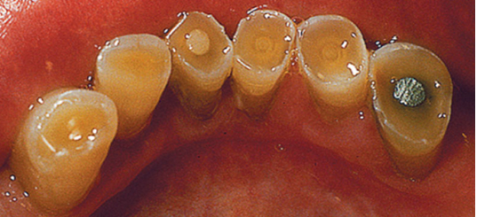 <p>41. What is seen on the incisal edge of the picture (Fig. 5.27)?</p><p>a. Recession</p><p>b. Abrasion</p><p>c. Attrition</p><p>d. Abfraction</p>