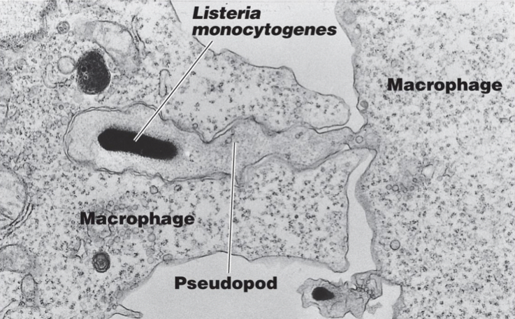 Listeriosis