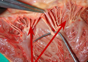 <p>What is the Chordae Tendineae and Papillary Muscles help with what?</p>