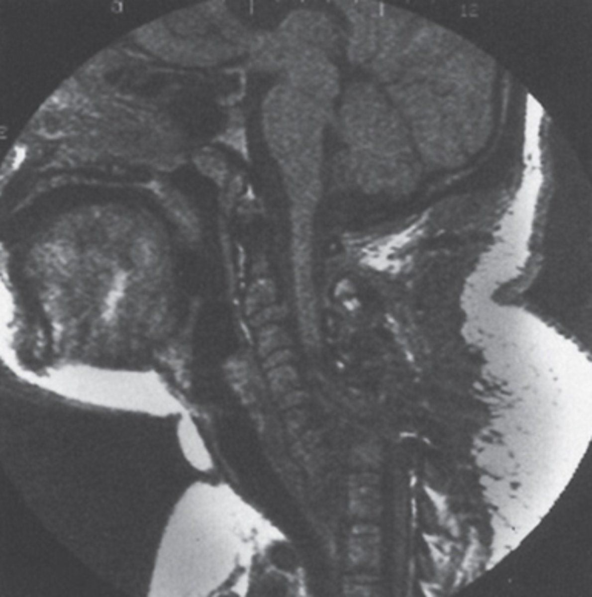 <p>Regarding the patient shown, which of the following is true?</p><p>The condition probably predated the trauma.</p><p>The prospects for a full recovery are good.</p><p>Surgical repair will likely be successful.</p><p>The patient will probably never have normal neurologic function below C6.</p><p>The spinal cord is intact.</p>