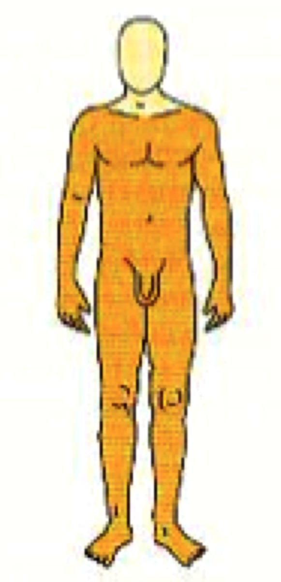 <p>-damage to the cervical area of the spinal cord <br>-loose function neck down</p>