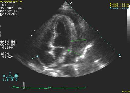 <p><span>What would be a primary concern for the patient with pericarditis in the photo above?</span></p><p></p><p>developing a pleural&nbsp;effusion</p><p></p><p>myocardial infarction</p><p>&nbsp;</p><p>developing tamponade</p><p>&nbsp;</p><p>developing an outflow tract obstruction</p>