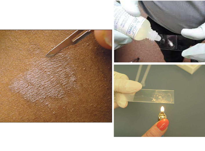 <p>microscopie</p><ul><li><p>wat : schilfers, haren, nagelfragmenten</p></li><li><p>aankleuren met 10-30% KOH </p></li><li><p>schimmeldraden opsporen</p></li></ul><p>cultuur : duurt tot 1 maand</p><p></p>