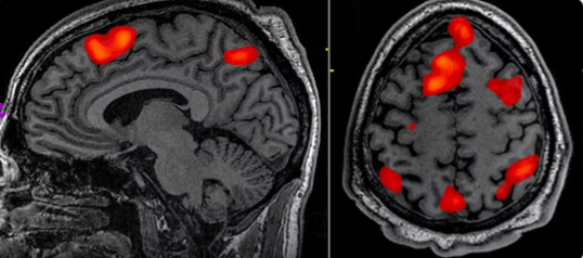 <p>Measures brain activity by detecting changes in blood flow and oxygen levels</p>