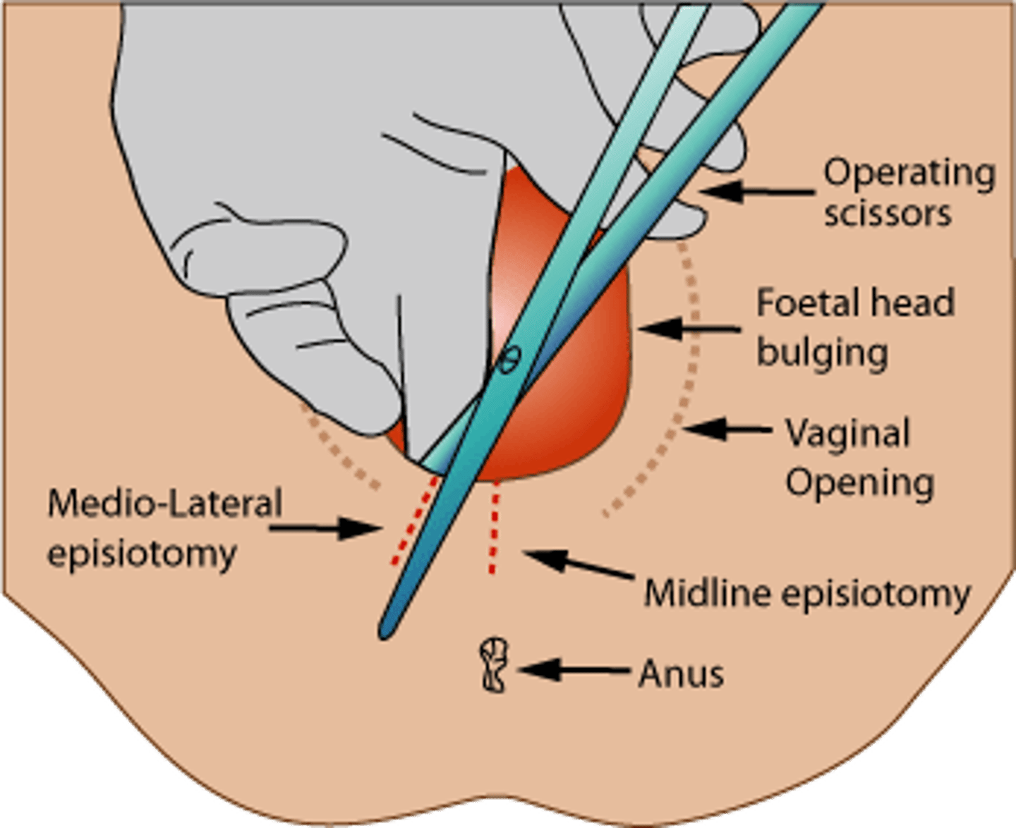 <p>is a surgical incision of the posterior aspect of the vulva made during the second stage of labor</p><p>is used if the patient is at high risk for a third- or fourth-degree perineal tear or if an expedited delivery is needed because of fetal compromise.</p><p>Risks include infection, bleeding, and pain.</p>