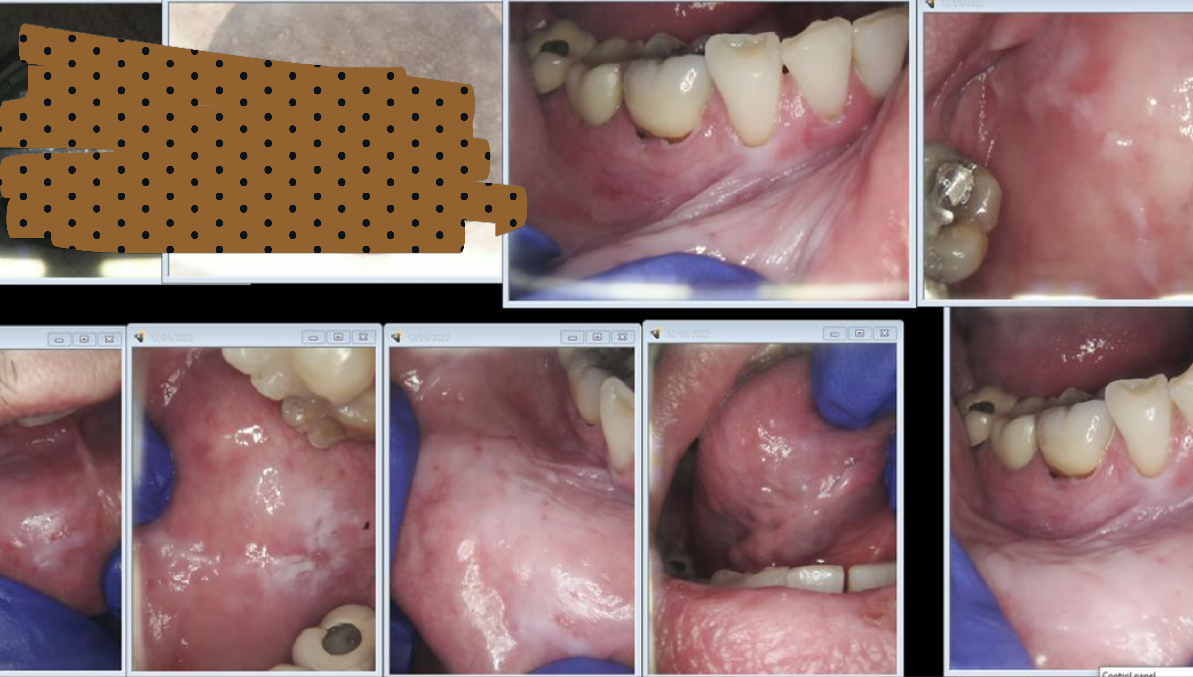 <p>which environmental/reactive lesion:</p><ul><li><p>Contact with caustic agents within the tobacco</p></li><li><p>Early: grayish-white wrinkles and parallel ridges and fissures in the area where the tobacco is placed - Reversible</p></li><li><p>Advanced: well-demarcated, keratotic plaques</p><ul><li><p>Must be biopsied for evaluation of dysplasia</p></li><li><p>Regular follow up</p></li></ul></li></ul><p></p>