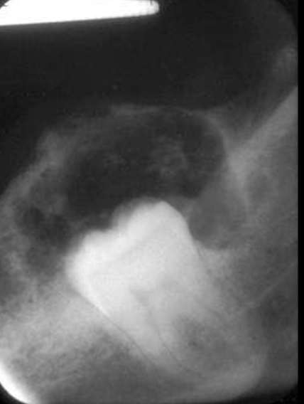 <ol><li><p>mixed density- central radiolucency with radiopaque foci </p></li><li><p>maybe associated w/ unerupted tooth</p></li><li><p>expansile- expands cortex</p></li><li><p>root resorption possible</p></li></ol><p></p>