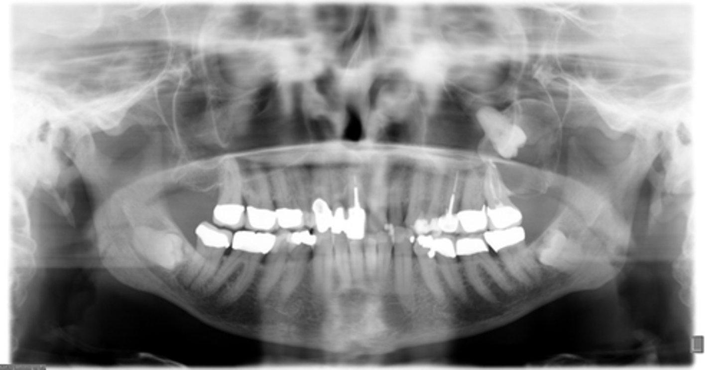<p>You patient presents with a pano exhibiting a well defined, corticated, unilocular radiolucency associated with the crown of an unerupted #16. What type of biopsy should you take first?</p><p>- Aspiration</p><p>- Cytology</p><p>- Incisional</p><p>- Excisional</p>