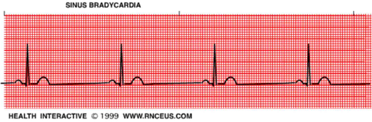 <p>Slow heart-rate (less than 60 bpm).</p>