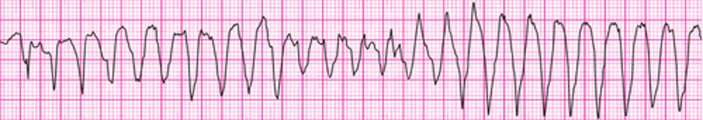 <p>Torsades de pointes</p>