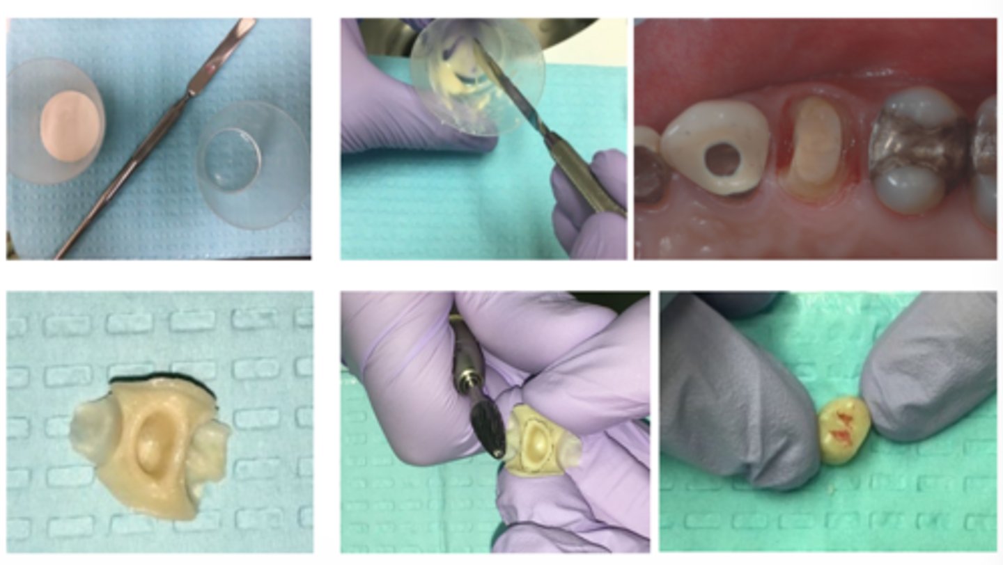 <p>Which temp fabrication technique is shown here?</p>