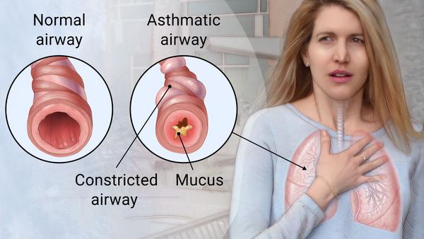 <p>An immune-related disease that causes <strong>inflammation</strong> and <strong>mucus production</strong> in the small airways (bronchioles) and makes the airway muscles overly responsive, leading to <strong>airway obstruction</strong>.</p>