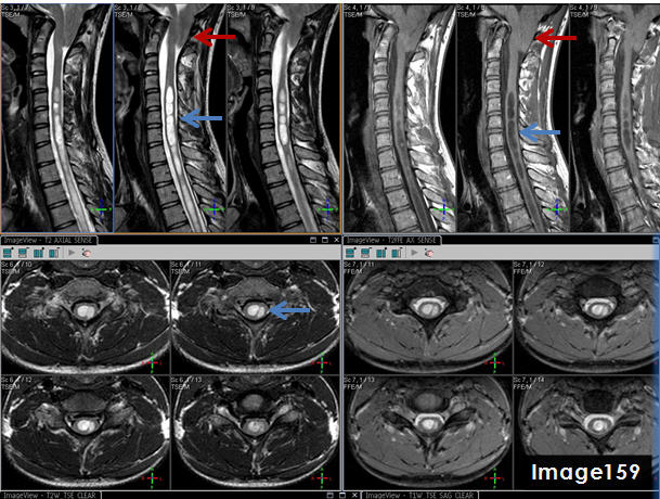 <p>The blue arrows in Image 159 point to what pathology?</p>