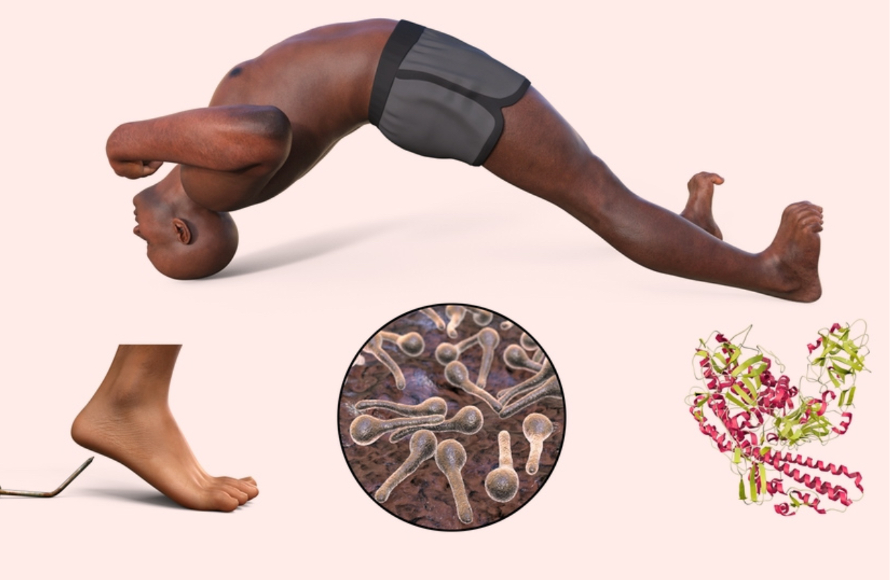 <p><span>Agent: </span><em><span>Clostridium tetani</span></em></p><p><span>Transmitted through: puncture wound</span></p><p>Signs and symptoms: <span><strong><span>Tightening of the jaw and neck muscles</span></strong></span></p><p><span><span>-Sweating, drooling, grouchiness, and </span><strong><span>constant back spasms</span></strong></span></p><p>-<span><span>Spasms and contractions may increase and spread to cause curled arms, fists, and feet, and the body arches backwards as the heel and back of the head bend towards each other</span></span></p>