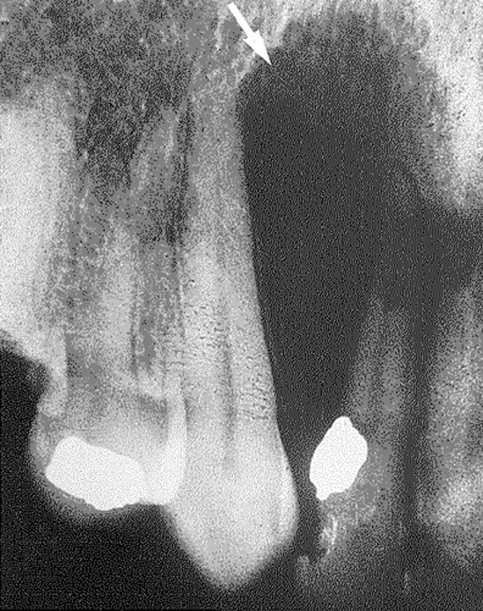 <p>globulomaxillary</p><p>The globulomaxillary cyst is a pear-shaped radiolucency found between the roots of a maxillary lateral and cuspid. The radicular cyst is a root end cyst found at the apex of a tooth that is usually involved with caries. A lateral periodontal cyst is usually found between the roots of the mandibular cuspid and premolar. The nasopalatine canal cyst is usually heart shaped and found near the apices of the maxillary centrals, lingual aspect.</p>