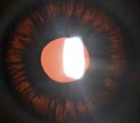 <p>Transillumination defects </p>
