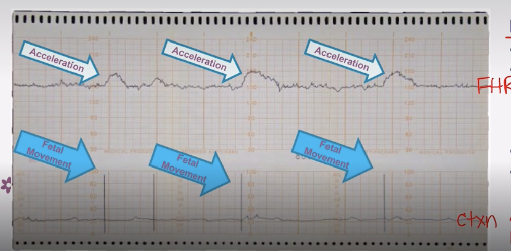 <p>-IS GOOD!<br>-Normal baseline → Fetal HR stays consistent on a line in between accelerations</p><p> -Acceleration of Fetal HR aligns with a Uterine Contraction</p><p>-Moderate Variability → Moderate Squiggles  </p><p>-No decelerations noted</p>