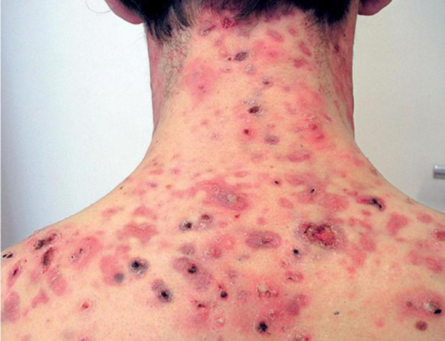 <p>a chronic, highly inflammatory form of cystic acne in which involved areas contain a mixture of double comedones, two blackheads that communicate under the skin, papules, pustules, communicating cysts, abscesses, and draining sinus tracts</p>