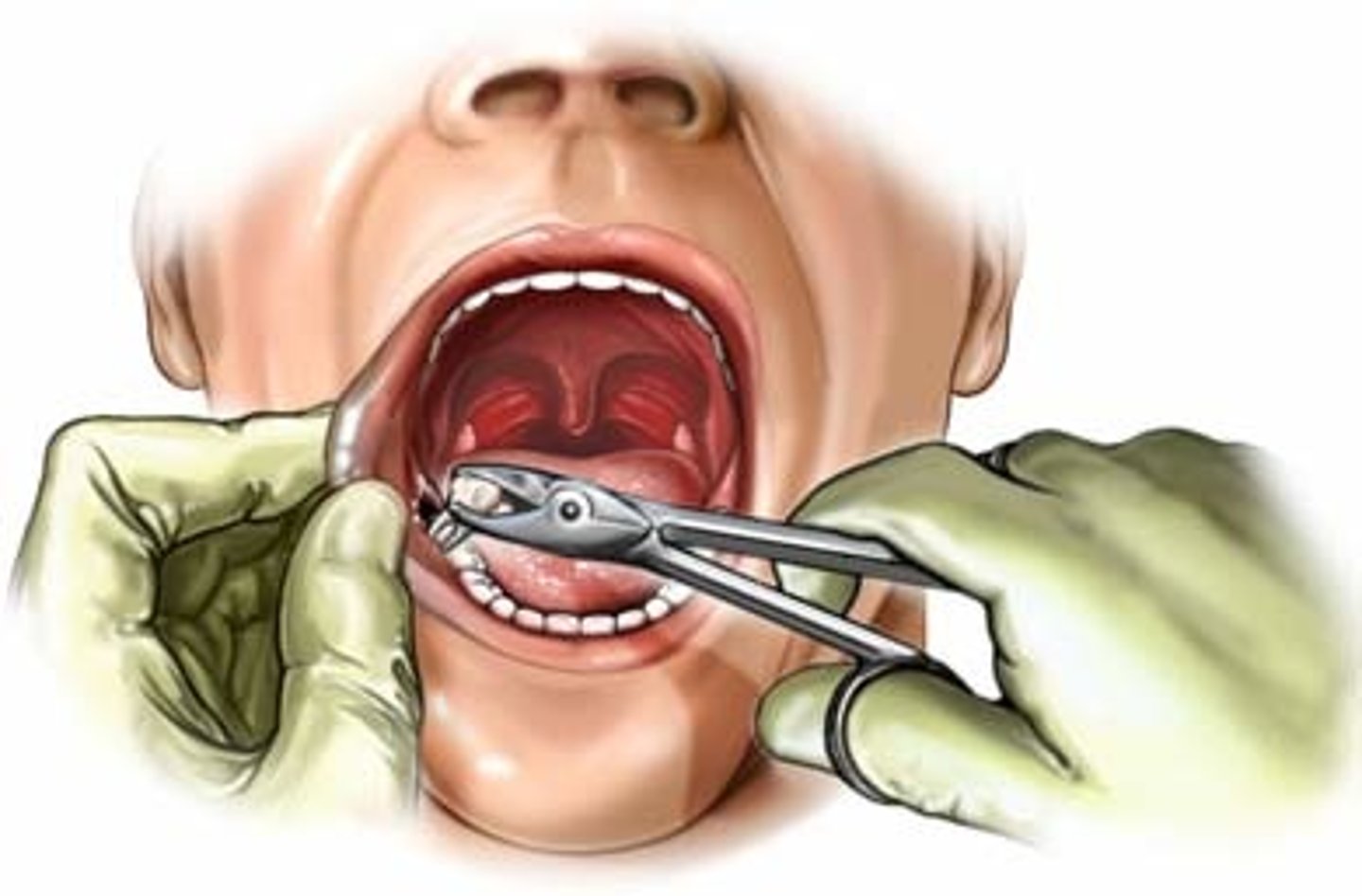 <p>direct trauma associated w/ a surgical procedure such as dental extraction or orthognathic surgery</p>