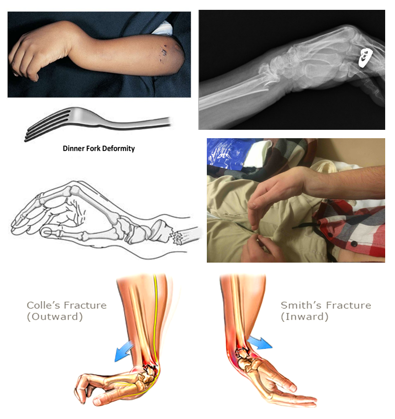 <p>-Colles fx (distal radial head dorsal displacement)</p><p>-Smiths fx (distal radial head volar displacement)</p>