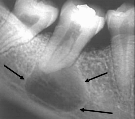 <p>Why is this Radicular cyst less circular/oval in this case?</p>
