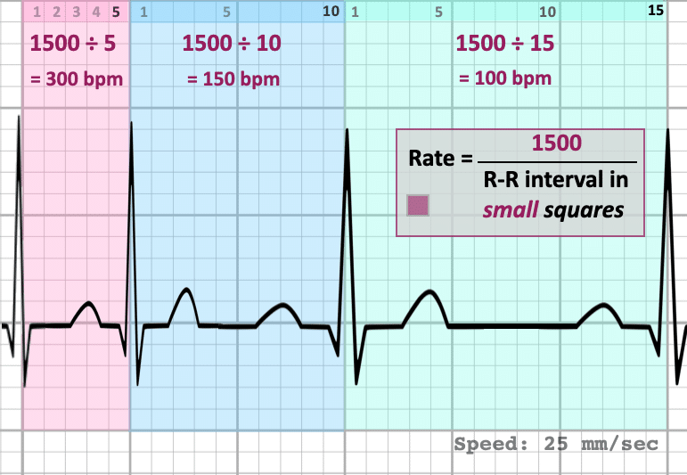 <ul><li><p><span><span>most appropriate with fast rhythms (must be regular), count squares between two R waves, divide 1500 by that number</span></span></p></li></ul><p></p>