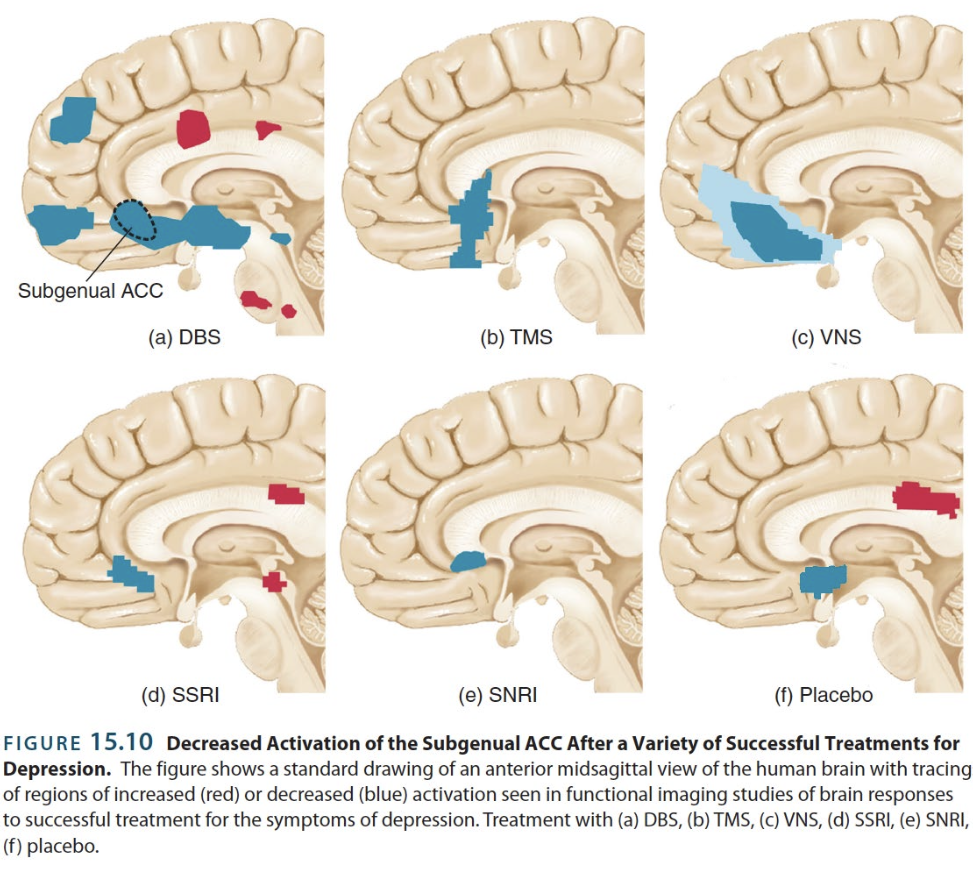 <p>→ fMRIs reveal less activity after depression symptoms remiss</p><ul><li><p>Though clinical trials targeting this region with biomedical electrical treatments have been unsuccessful thus far</p></li></ul><p></p>