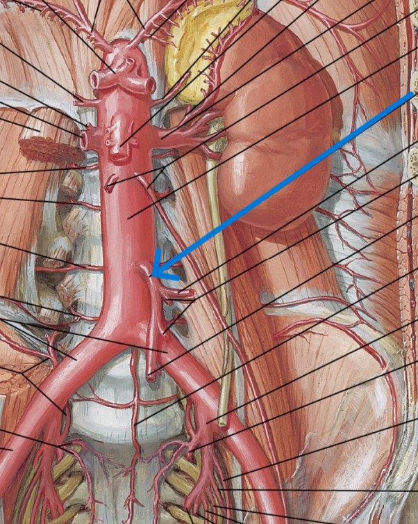 <p>Which arteries:</p><ul><li><p>Superior to common iliac (L&amp;R) artery</p></li></ul><p></p>
