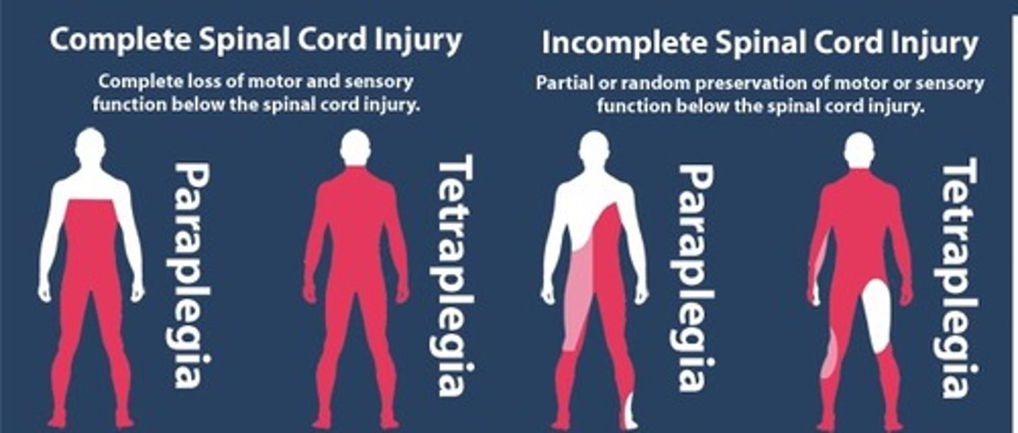 <p>Complete spinal cord injury </p>