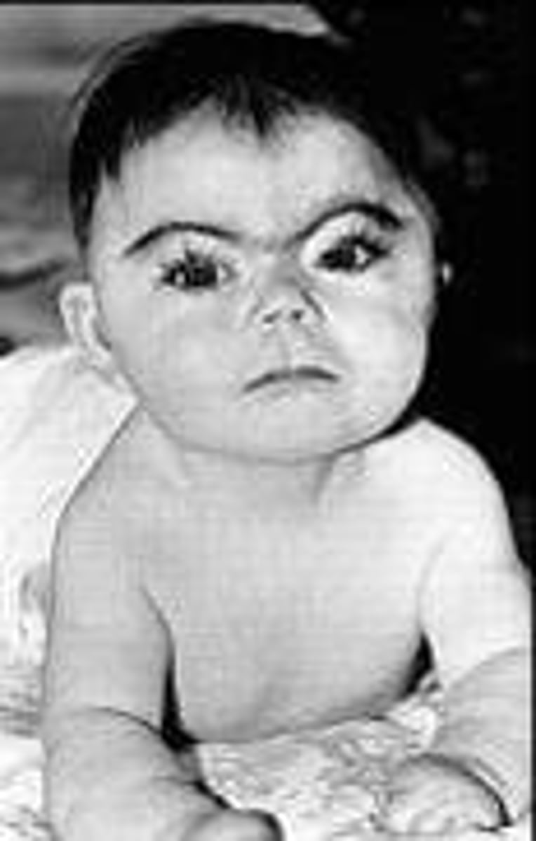 <p>IUGR, hypertonia, distinctive facies, limb malformation, self-injurious behavior, hyperactive.</p>