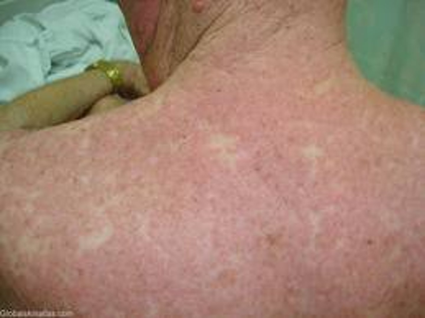 <p>lesions that run together<br><br>example: small-vessel vasculitis</p>