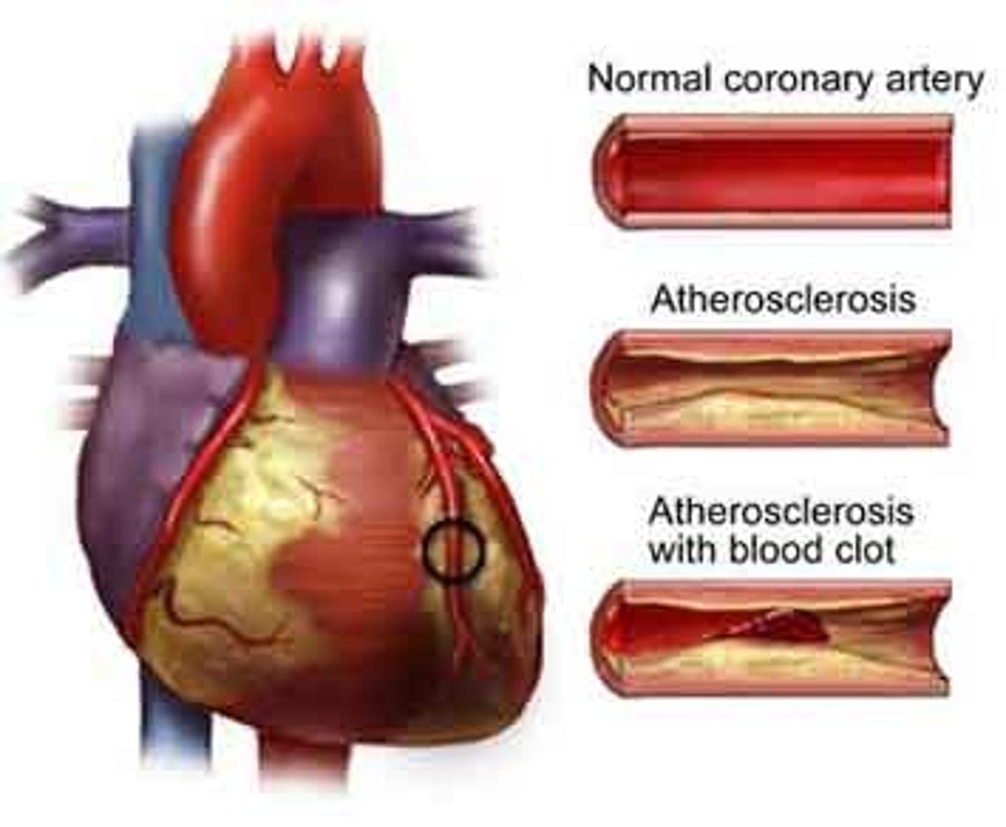 <p>narrowing of arteries due to plaque buildup</p>