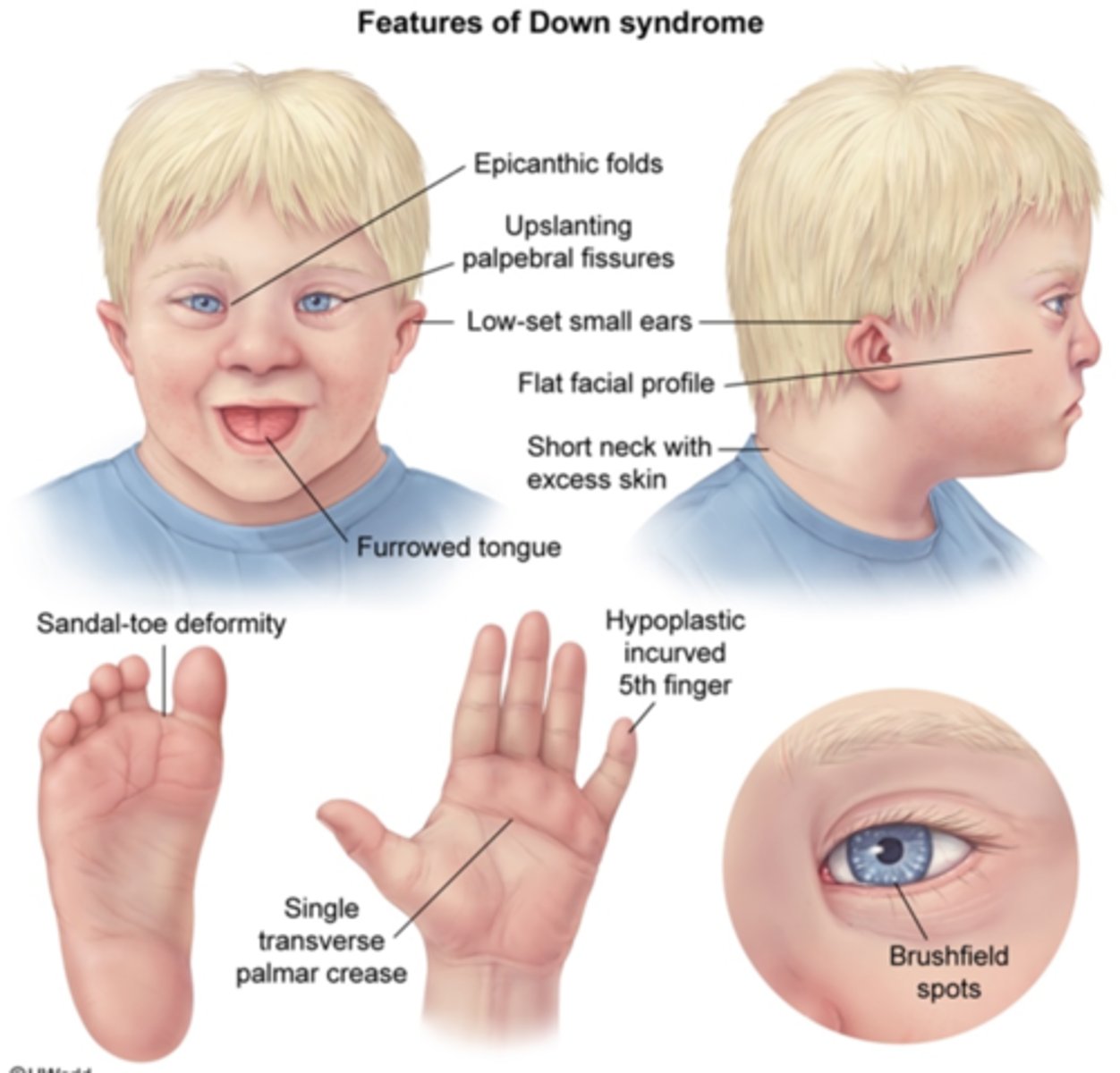 <p>Down Syndrome (Trisomy 21)</p>