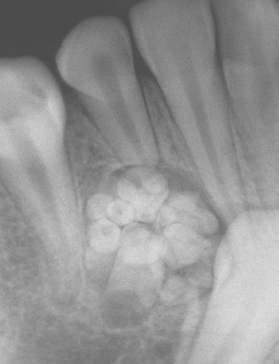 <p>cluster of miniature teeth (or extra mini tooth)</p>