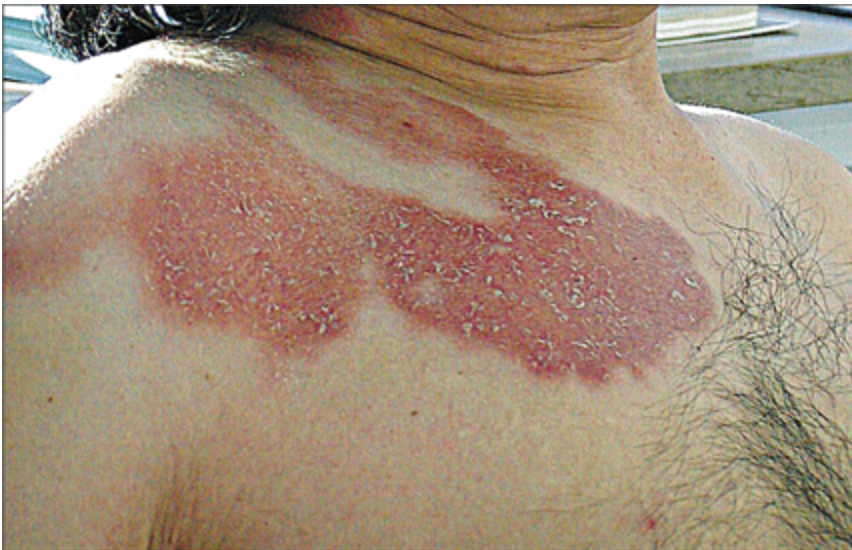 <p>A 23 y/o Texas cowboy presents to the clinic for muscle weakness and sensory changes. He states that he wrangles 9-banded armadillos in his spare time. On physical exam you note a hypopigmented, patch like rash. What are your diagnostic technqiues?</p>