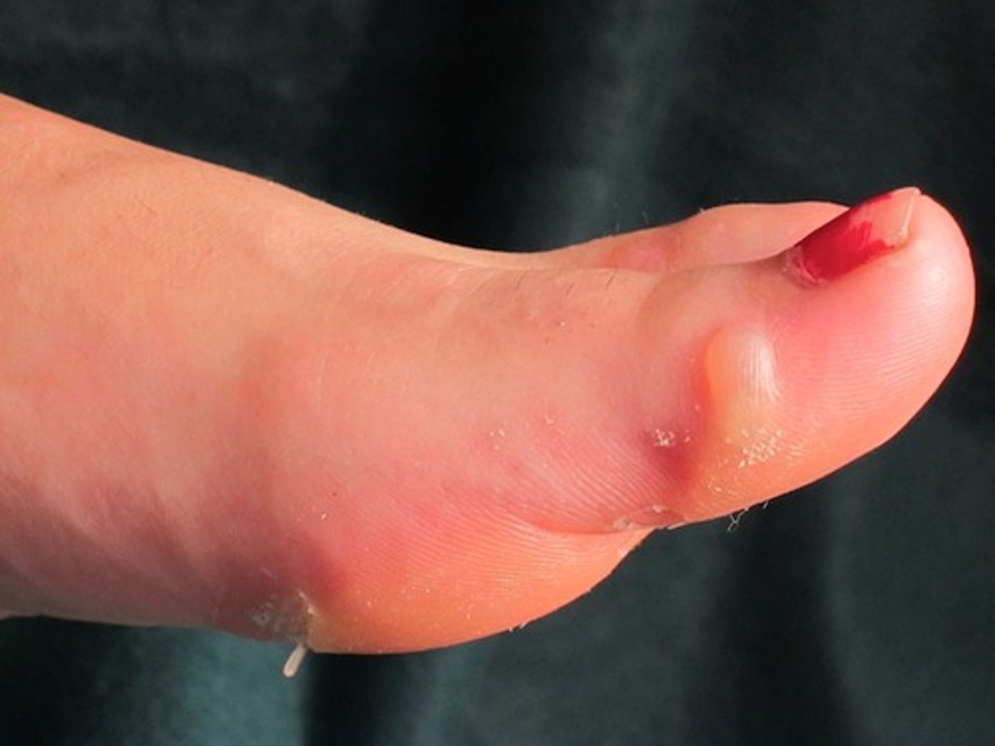 <p>a blister (also a light bulb)</p>