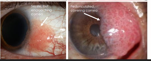 <ol><li><p><strong><u>• Bilateral conjunctival injection (redness) </u></strong></p><ol><li><p>• Dilated conjunctival vessels giving red eye appearance</p></li></ol></li><li><p><strong><u> • Bilateral white -gray, painless, elevated gelatinous, spongy, plaques </u></strong></p><ol><li><p>• Location: nasal or temporal perilimbal area with possible extension onto cornea</p></li><li><p> • Also apparent on<strong><u> oral cavity • Mouth, lip, tongue</u></strong></p></li></ol></li></ol><p></p>