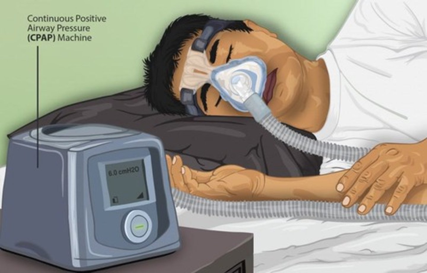 <p>increasing atmospheric pressure at the pt's mouth</p><p>increases partial pressure and increases total pressure</p><p>continuous pressure</p>