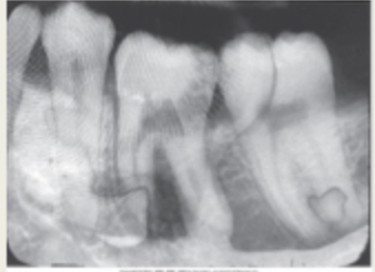 <p>What causes the<strong> fingerprint artifact</strong>?</p>