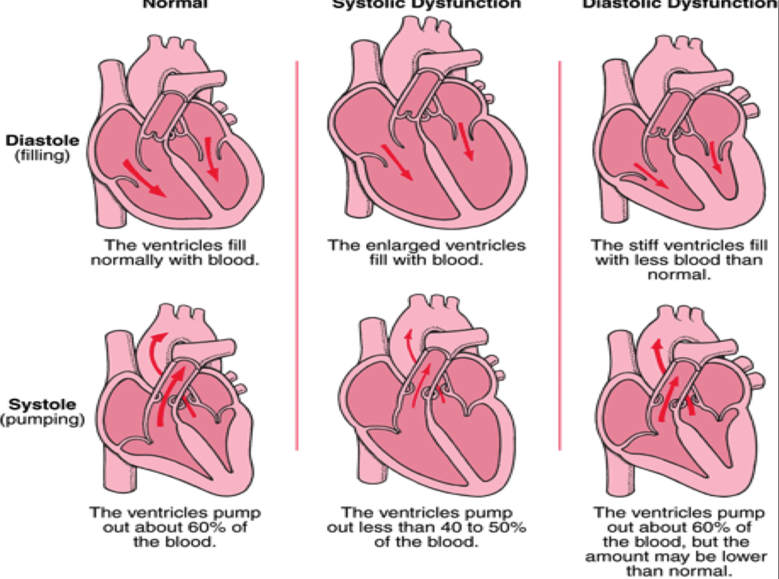 <p>HFpEF</p>